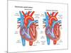 Ventricular Septal Defect-Encyclopaedia Britannica-Mounted Poster