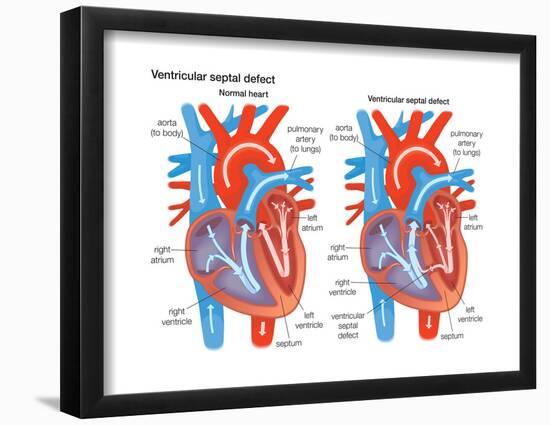 Ventricular Septal Defect-Encyclopaedia Britannica-Framed Poster