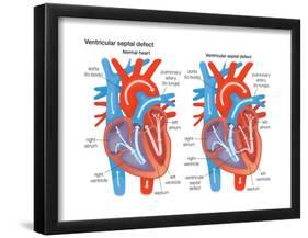 Ventricular Septal Defect-Encyclopaedia Britannica-Framed Poster