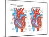 Ventricular Septal Defect-Encyclopaedia Britannica-Mounted Poster