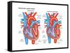 Ventricular Septal Defect-Encyclopaedia Britannica-Framed Stretched Canvas