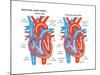 Ventricular Septal Defect-Encyclopaedia Britannica-Mounted Poster