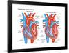 Ventricular Septal Defect-Encyclopaedia Britannica-Framed Poster