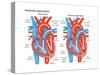 Ventricular Septal Defect-Encyclopaedia Britannica-Stretched Canvas