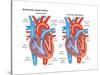 Ventricular Septal Defect-Encyclopaedia Britannica-Stretched Canvas