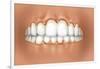 View of Teeth Showing Gingivitis on Gums-null-Framed Art Print