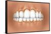 View of Teeth Showing Gingivitis on Gums-null-Framed Stretched Canvas
