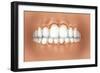 View of Teeth Showing Gingivitis on Gums-null-Framed Art Print