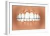 View of Teeth Showing Gingivitis on Gums-null-Framed Art Print