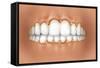 View of Teeth Showing Gingivitis on Gums-null-Framed Stretched Canvas