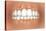 View of Teeth Showing Gingivitis on Gums-null-Stretched Canvas