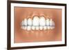 View of Teeth Showing Gingivitis on Gums-null-Framed Art Print