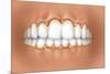 View of Teeth Showing Gingivitis on Gums-null-Mounted Art Print