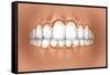 View of Teeth Showing Gingivitis on Gums-null-Framed Stretched Canvas