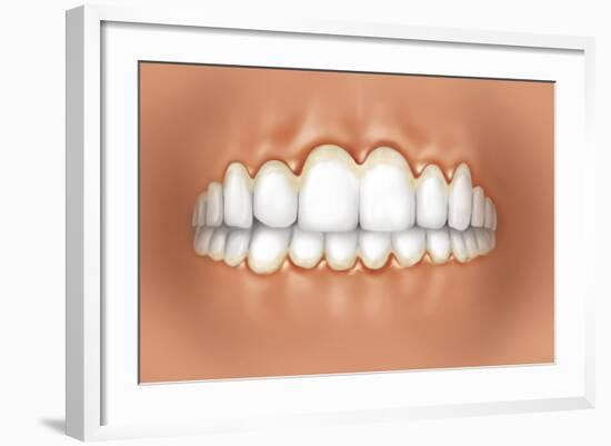 View of Teeth Showing Gingivitis on Gums-null-Framed Art Print