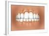 View of Teeth Showing Gingivitis on Gums-null-Framed Art Print
