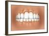 View of Teeth Showing Gingivitis on Gums-null-Framed Art Print