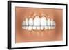 View of Teeth Showing Gingivitis on Gums-null-Framed Art Print