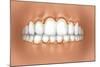 View of Teeth Showing Gingivitis on Gums-null-Mounted Art Print