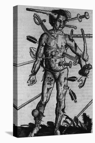 Wound Man Illustrates Effects of Different Weapons. by Hans Wechtlin, Ca. 1500-null-Stretched Canvas