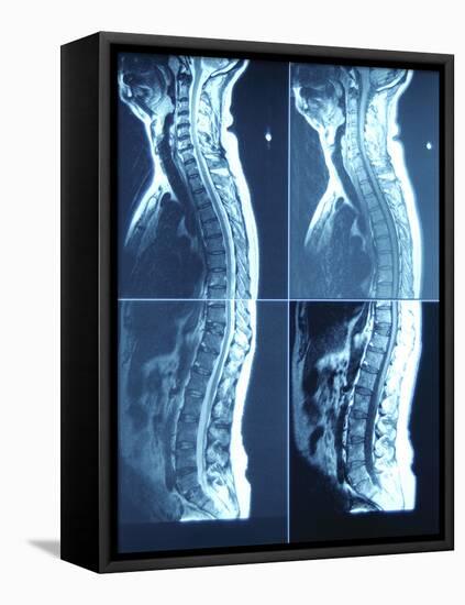 X-Ray Image of Person's Spine on Computer Screen-null-Framed Stretched Canvas