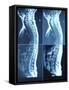 X-Ray Image of Person's Spine on Computer Screen-null-Framed Stretched Canvas