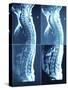 X-Ray Image of Person's Spine on Computer Screen-null-Stretched Canvas