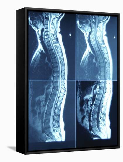 X-Ray Image of Person's Spine on Computer Screen-null-Framed Stretched Canvas