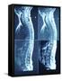 X-Ray Image of Person's Spine on Computer Screen-null-Framed Stretched Canvas