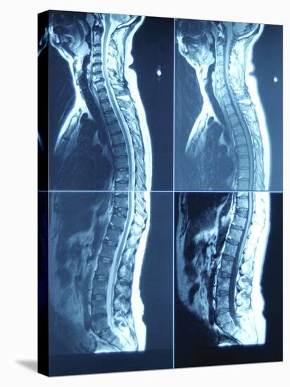 X-Ray Image of Person's Spine on Computer Screen-null-Stretched Canvas