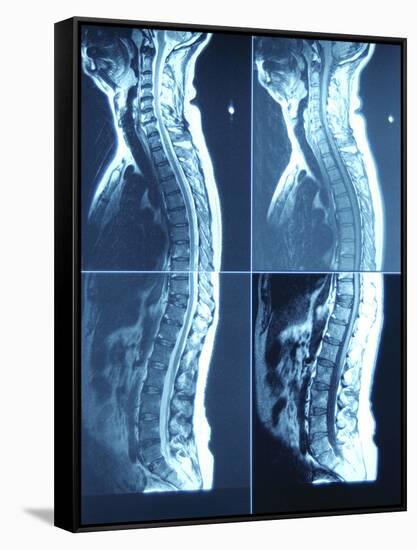 X-Ray Image of Person's Spine on Computer Screen-null-Framed Stretched Canvas