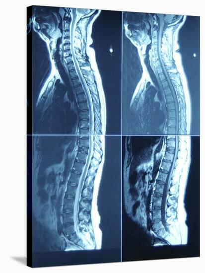 X-Ray Image of Person's Spine on Computer Screen-null-Stretched Canvas