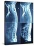 X-Ray Image of Person's Spine on Computer Screen-null-Stretched Canvas