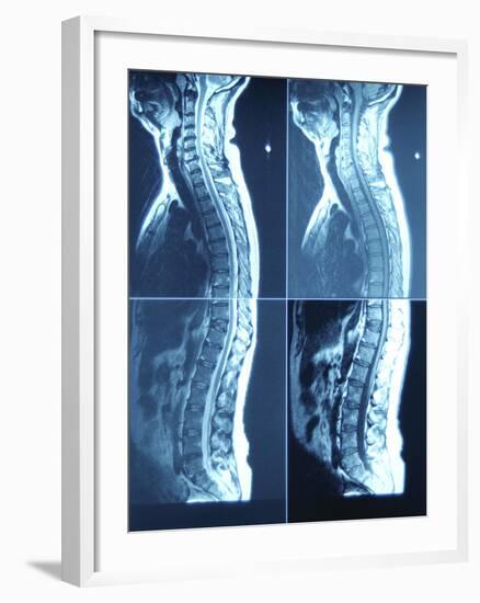 X-Ray Image of Person's Spine on Computer Screen-null-Framed Photographic Print