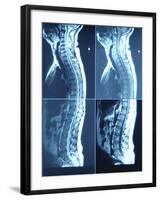 X-Ray Image of Person's Spine on Computer Screen-null-Framed Photographic Print