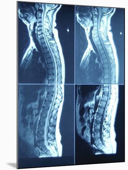 X-Ray Image of Person's Spine on Computer Screen-null-Mounted Photographic Print