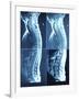 X-Ray Image of Person's Spine on Computer Screen-null-Framed Photographic Print