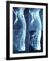 X-Ray Image of Person's Spine on Computer Screen-null-Framed Photographic Print