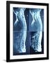 X-Ray Image of Person's Spine on Computer Screen-null-Framed Photographic Print