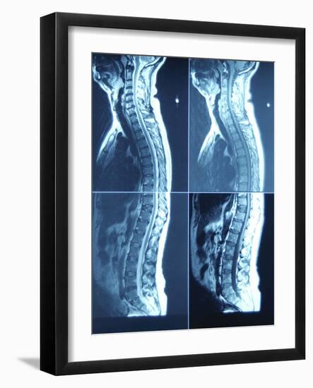 X-Ray Image of Person's Spine on Computer Screen-null-Framed Photographic Print