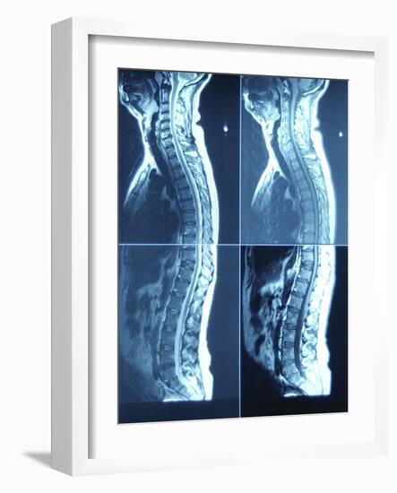 X-Ray Image of Person's Spine on Computer Screen-null-Framed Photographic Print