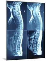 X-Ray Image of Person's Spine on Computer Screen-null-Mounted Photographic Print