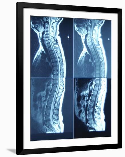 X-Ray Image of Person's Spine on Computer Screen-null-Framed Photographic Print