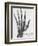 X-ray of a hand with buckshot-Science Source-Framed Giclee Print