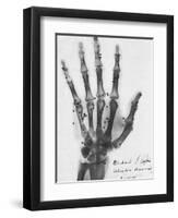 X-ray of a hand with buckshot-Science Source-Framed Giclee Print