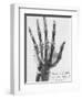 X-ray of a hand with buckshot-Science Source-Framed Giclee Print