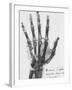 X-ray of a hand with buckshot-Science Source-Framed Giclee Print