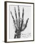 X-ray of a hand with buckshot-Science Source-Framed Giclee Print