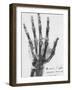 X-ray of a hand with buckshot-Science Source-Framed Giclee Print