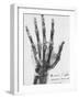 X-ray of a hand with buckshot-Science Source-Framed Giclee Print